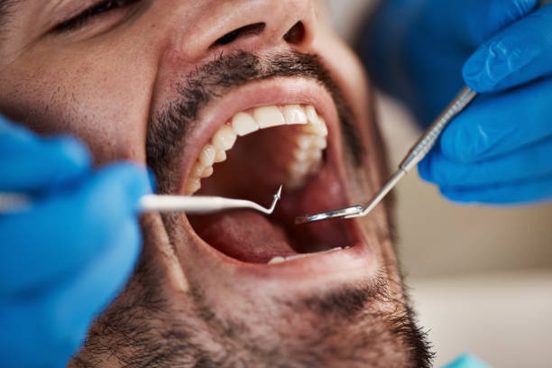 Best Emergency Wisdom Teeth Removal in Southmont, NC